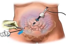 Laparoscopic-Colorectal