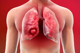Lung-cancer